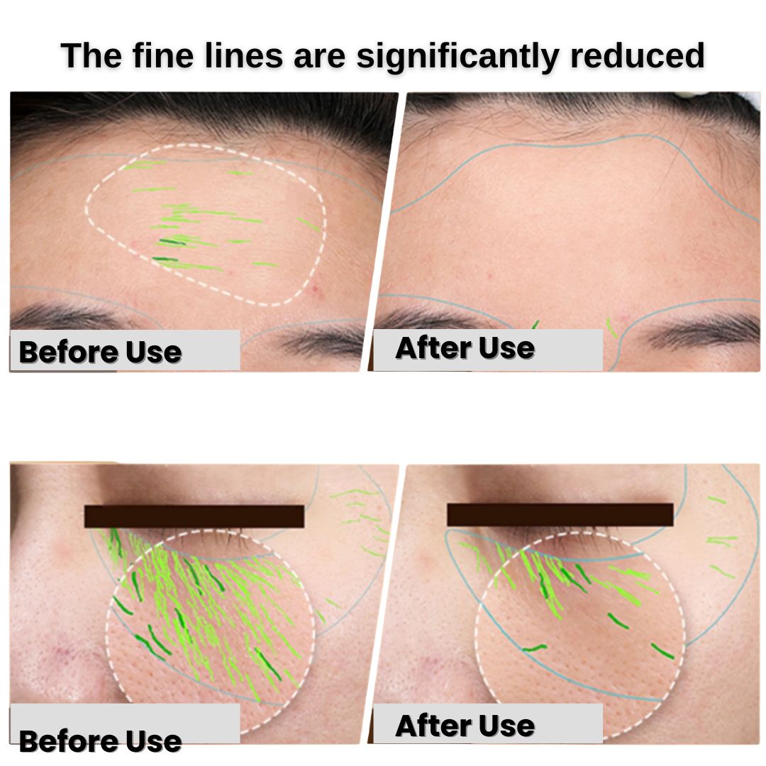 RF SkinLift Pro. Lift, firm, and glow — starting today